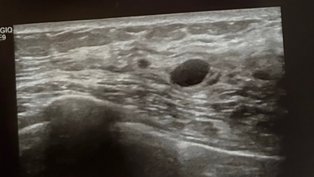 LIFE UPDATEI Discovered a LUMP In My BreastVery Painful Breast Biopsy