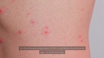 FLESH EATINGN DESEASE: Understanding Necrotizing Fasciitis: The Deadly Flesh-Eating Disease