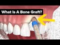 Dental bone grafts explained