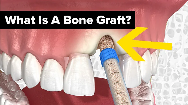 Dental Bone Grafts Explained