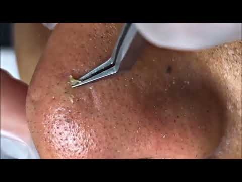 Blackhead on faceacne comfortable blackhead pimple