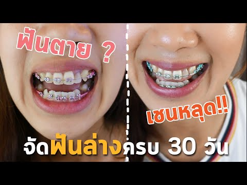 รีวิวจัดฟันล่างครบ 30 วัน | กับฟันบนหนึ่งซี่ที่มีปัญหา | ตกลงฟันช็อค หรือ ฟันตาย !!??