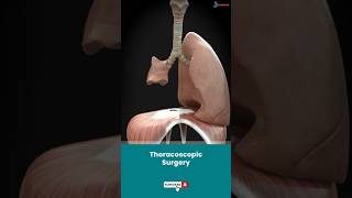 Video-Assisted Thoracoscopic Surgery (VATS)↪3D Medical Animation #Shorts #ThoracoscopicSurgery #VATS