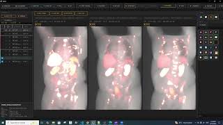 PETCT Longitudinal Analysis using Deformable Registration