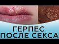 Герпес после секса