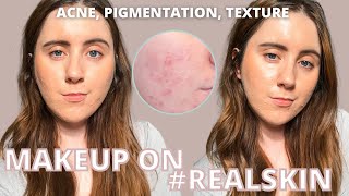 A 5 Minute Make Up Routine On Acne, Pigmentation, Skin Texture