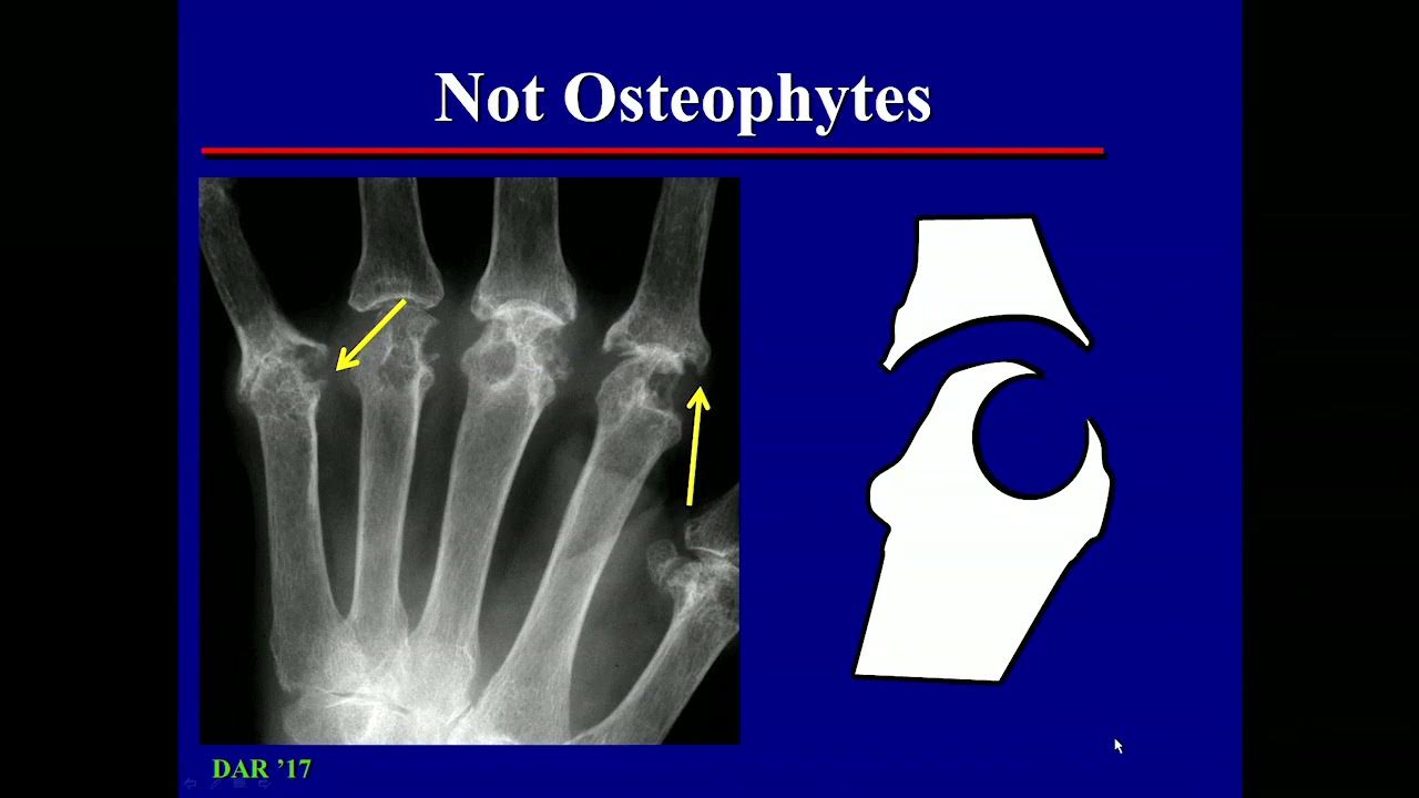 osteophytes x ray