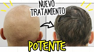 BARICITINIB para la ALOPECIA ¡NUEVO TRATAMIENTO | Olumiant Calvicie