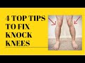 TOP TIPS TO FIX KNOCK KNEES WITHOUT SURGERY- Physio Advice