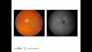 Lesson 12 Macular Degeneration Introduction