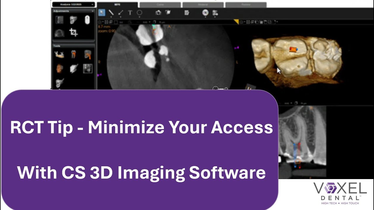 Root Canals - Minimize Your Access Using Carestream Dental's CBCT