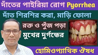 দাঁতের পাইরিয়ার হোমিওপ্যাথি ঔষধ । Pyorrhea homeopathic treatment