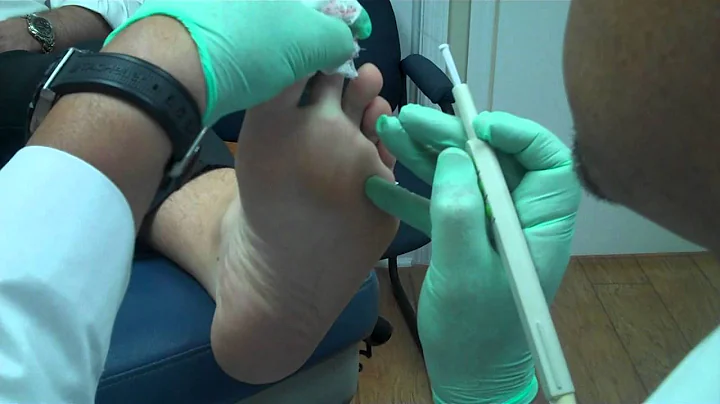 Wart removal and Hyfercation of wart by Dr. Dean D...