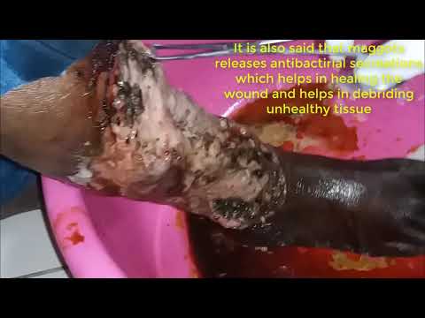 How maggots act as natural bio debridement agents and treatment - maggots therapy - medical video