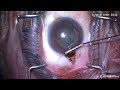 Iris prolapse during cataract surgery