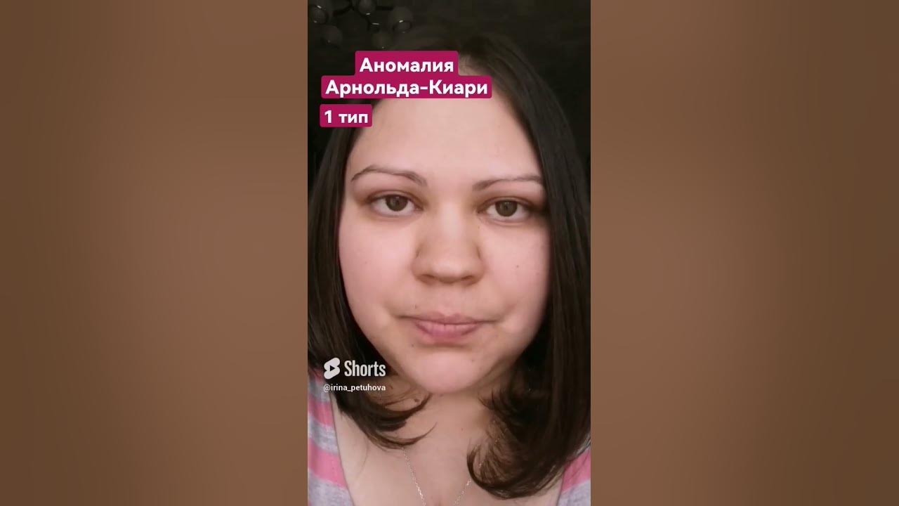 Аномалия Арнольда-Киари 1 и 2 типы #аномалия #аномалияарнольдакиари # ...