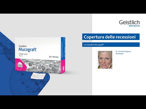 Copertura delle recessioni con Geistlich Mucograft®