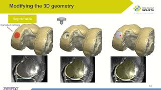 Improving Patient Outcomes with Patient-Specific Knee Models | Synopsys Simpleware Webinar