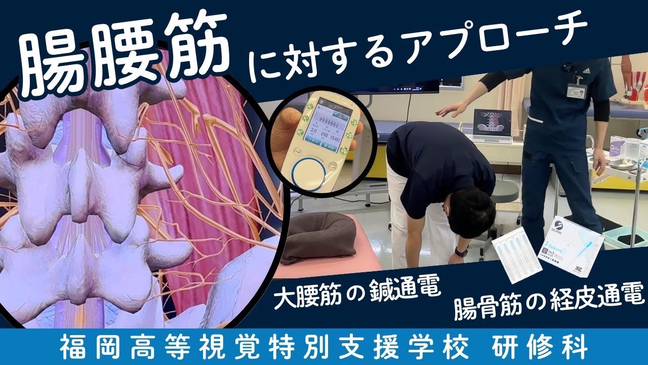 腸腰筋に対するアプローチ 大腰筋の鍼通電・腸骨筋の経皮通電