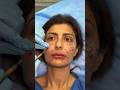 Restoring facial volume with Fat Transfer