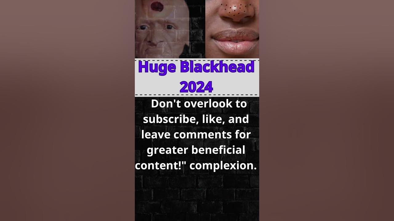 Perfect time every day with Videos Popping large Pimples and Blackheads