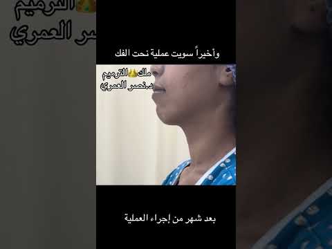 عملية تقديم الذقن اكسبلور تجميل تيك توك الدكتور نصر العمري