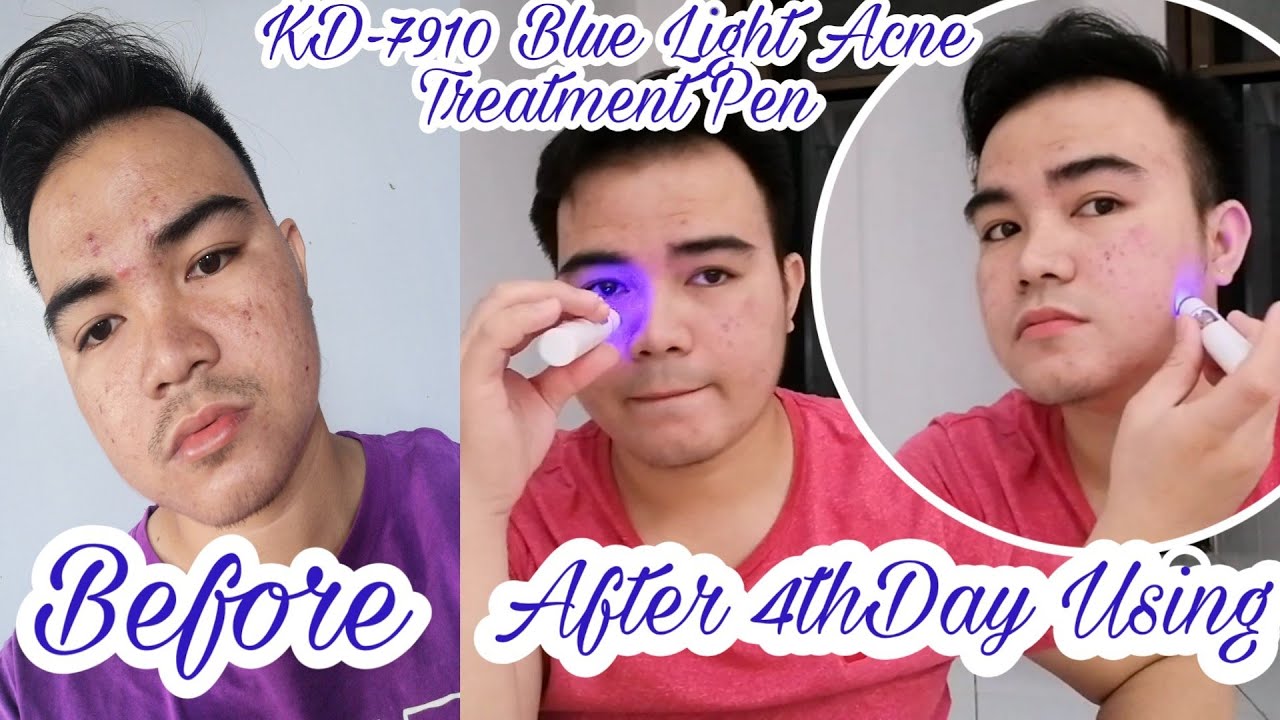 KD 7910 BlueLight Pen (updated) review YouTube