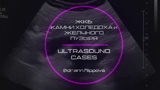 Камень ОБЩЕГО ЖЕЛЧНОГО ПРОТОКА на УЗИ🥔Холедохолитиаз. Choledocholithiasis on ultrasound 🔊