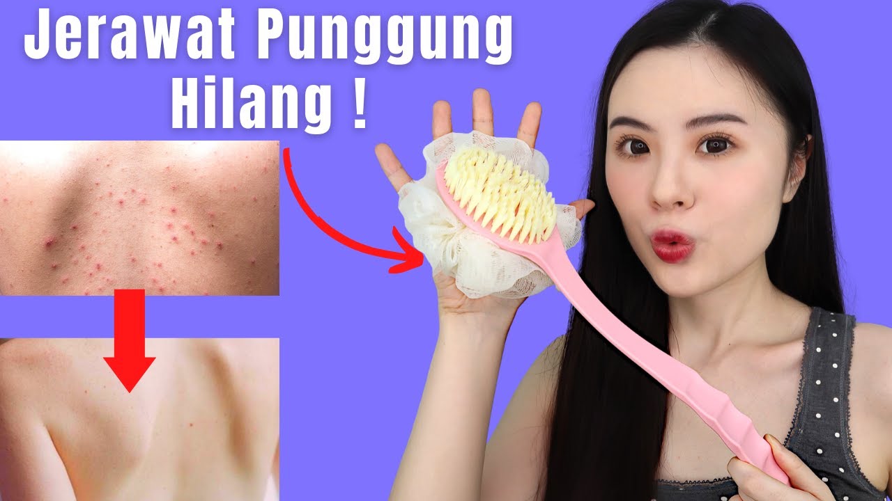 5 Cara Menghilangkan Jerawat Punggung dan Bekasnya (Alami)