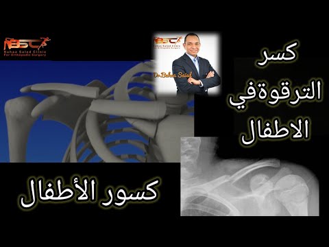 كسر الترقوة في الاطفال أنسب علاج