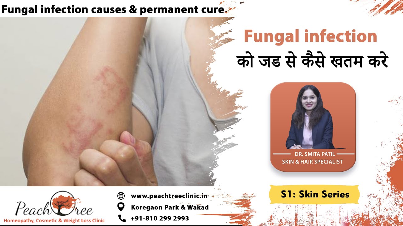 Fungal infection को जड से कैसे खतम करे । Fungal infection causes