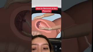 How does the removal of placenta look like?