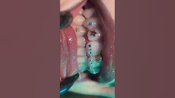 Elevate your smile with these gems