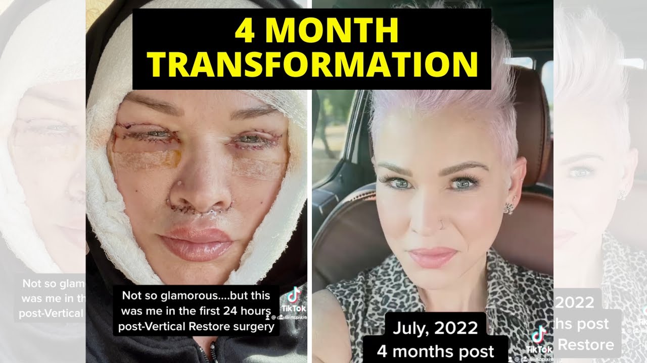 You won't believe this 4 Month Facelift Transformation!!