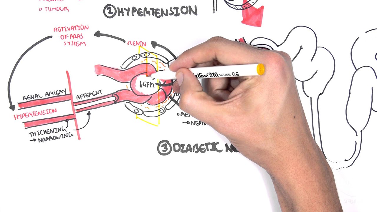 Chronic Kidney Disease CKD Pathophysiology YouTube