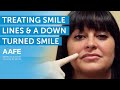 Treating Smile Lines and a Downturned Smile | AAFE