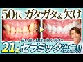 【50代男性】欠けた歯をセラミック治療！自慢の白い歯で自信を取り戻す！！