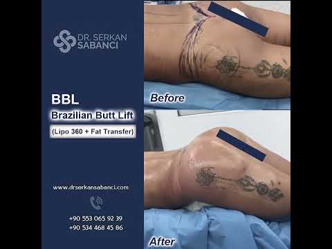 BBL Brazilian Butt Lift |  Op. Dr. Serkan Sabancı | Plastik Rekonstrüktif ve Estetik Cerrahi