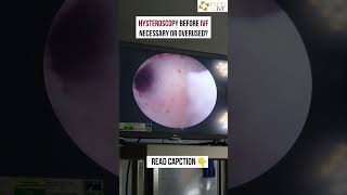 Hysteroscopy Before IVF – Necessary or Overused? Dr Rhythm Gupta -IVF specialist at Excel IVF