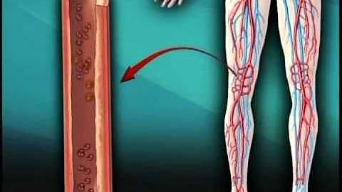 Como é uma morte por trombose?