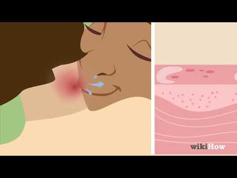 How To Give Someone A Hickey