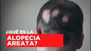 Qué Es La Alopecia Areata? Tratamiento Y Diagnóstico