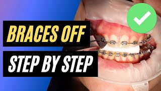 Top 13 How Long Does It Take To Remove Braces In 2022