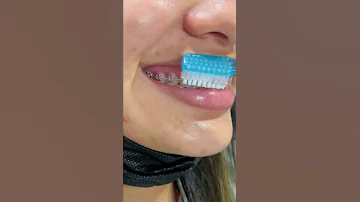 ¿Debo cepillarme los dientes 3 veces al día con ortodoncia?