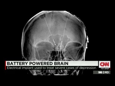 Video: Deep Brain Stimulation For Depression