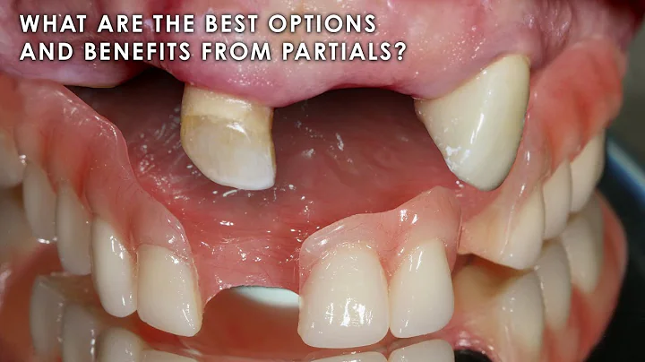 What are the Best Options and Benefits from Partials?