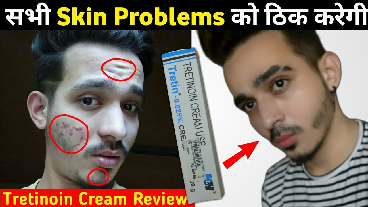 tretinoin cream 0.025 for stretch marks