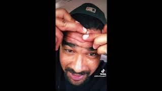 TikTok Pimple Popping Compilation - EP#13 ( Huge Cysts & Pimples)