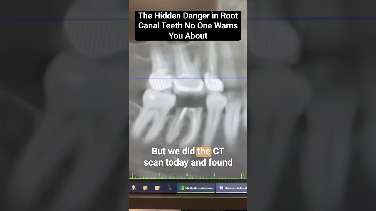 The Hidden Danger In Root Canal Teeth No One Warns You About Shorts