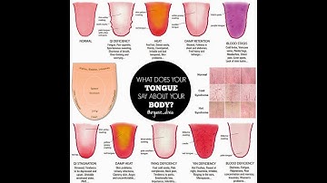 SDM E-Learning: Importance of Tongue diagnosis Part-3 (Dr. Geetha B Shetty)